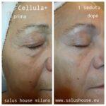 Cellula+ il nuovissimo trattamento viso con acidi AHA per ridurre rughe, macchie, pori dilatati