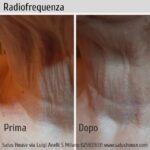 Radiofrequenza: risultati antiage straordinari sul viso, collo e decollété 